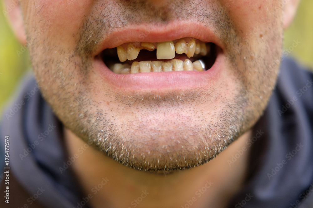 problems with teeth men of the European race problems with teeth men of the European race