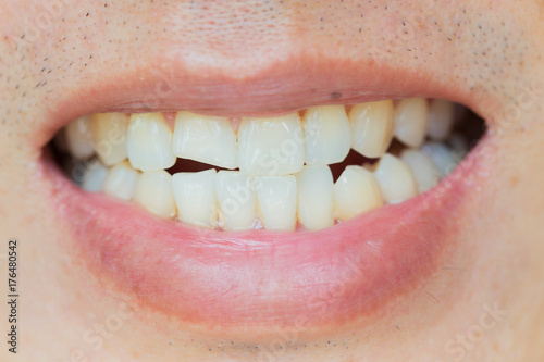 Teeth Injuries or Teeth Breaking in Male. Trauma and Nerve Damage of injured tooth, Permanent Teeth Injury