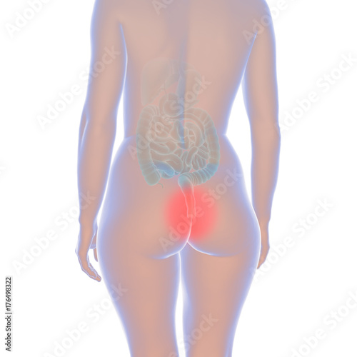 Hämorrhoiden bei einer Frau
