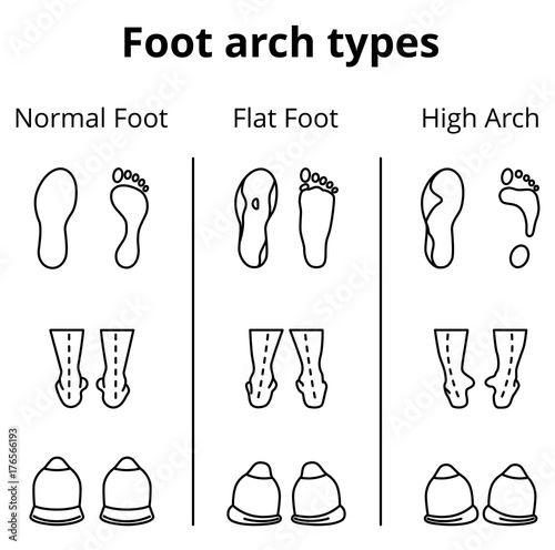 Foot arch types vector infographics. Set of flat foot, high arch