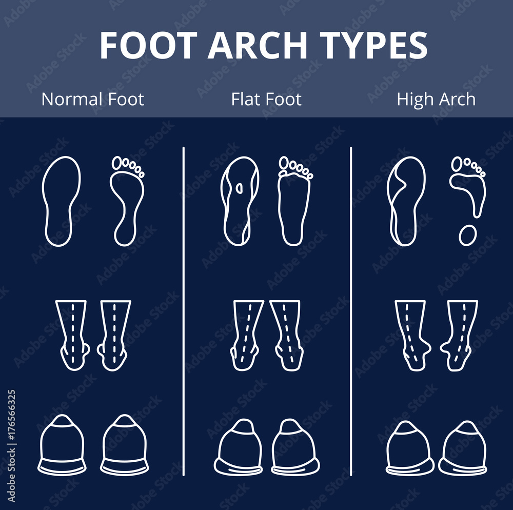 Foot arch types vector infographics. Set of flat foot, high arch Stock