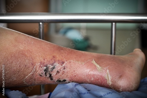 Φωτογραφία The feet of people with diabetes, dull and swollen