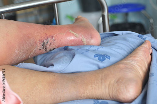 The feet of people with diabetes, dull and swollen. Due to the toxicity of diabetes, ulceration