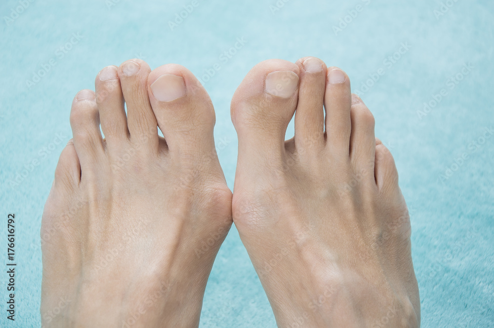 Hallux valgus, bunion in a leg on a blue soft background Hallux valgus, bunion in a leg on a blue soft background
