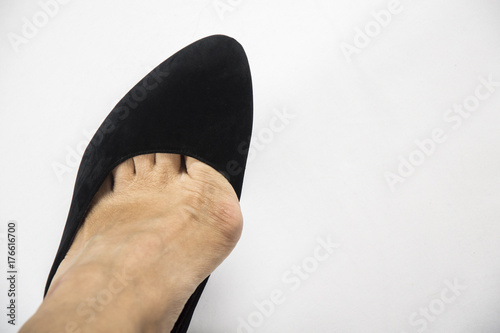 woman wore stilettos. Hallux valgus using narrow shoes.on a white background photo