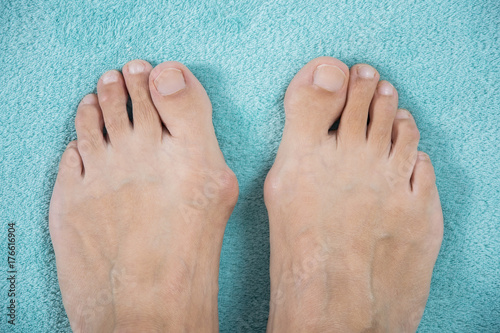 Hallux valgus, bunion in a leg on a blue soft background