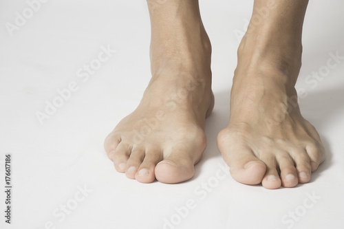 Hallux valgus, bunion in foot on white background