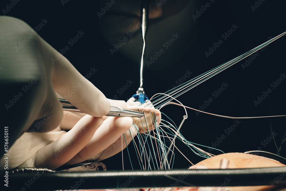 Φωτογραφία Team of surgeons minimally invasive aortic valve surgery replacement with sutures placed of each commissure suspended