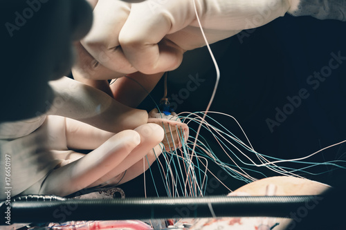 Team of surgeons minimally invasive aortic valve surgery replacement with sutures placed of each commissure suspended. Sutures are placed through the annulus and through the aortic prosthesis and tied photo