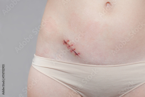 wound from appendicitis removal surgery on body