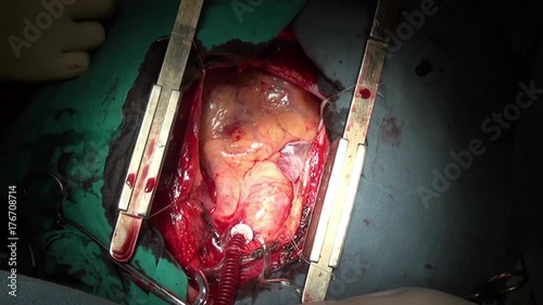 Heart surgery professional doctor hands unique macro video close up in clinic. Struggle for life. Operation on live organ of patient in hospital.