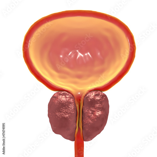 Konstfotografi Benign prostatic hyperplasia, 3D illustration showing enlarged prostate gland