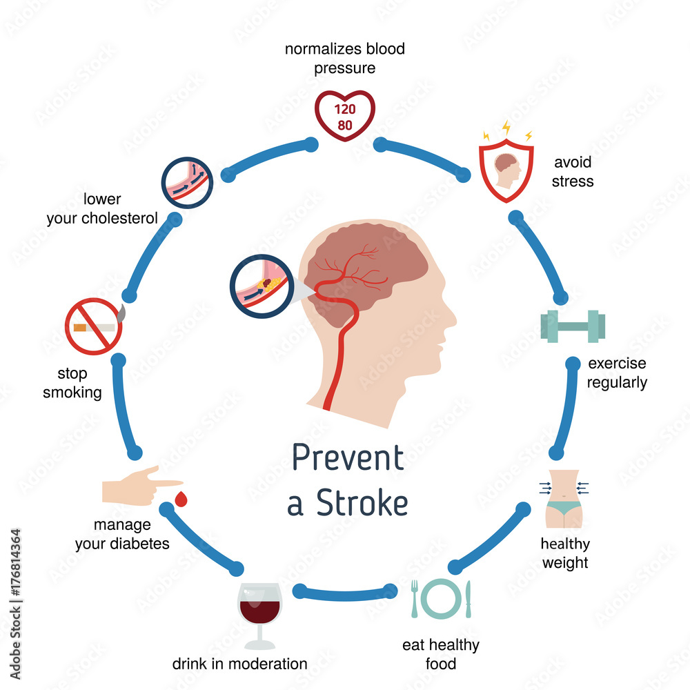 Infographics for stroke Stock Vector | Adobe Stock