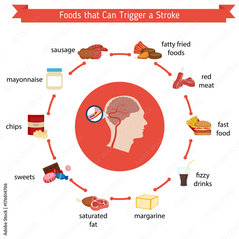 Obraz premium Infographics for stroke