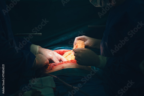 Surgeon hands with white sterile gloves operate with an electric scalpel or cauter electrosurgical, resecting a tumor, using surgery operation room remove cancer tumor surgery photo