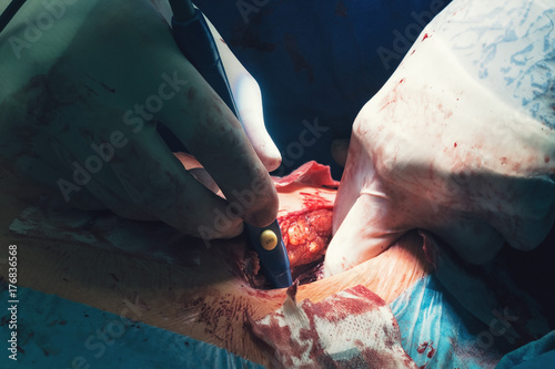 Surgeon hands with white sterile gloves operate with an electric scalpel or cauter electrosurgical, resecting a tumor, using surgery operation room remove cancer tumor surgery photo