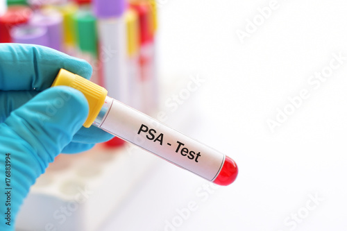 Blood sample for PSA (prostate specific antigen) test, diagnosis for prostate cancer photo