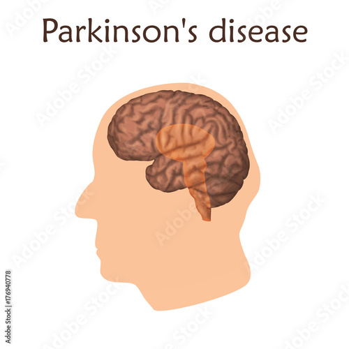 Parkinson's disease poster, banner. Vector medical illustration. White background, pink silhouette of old man head, anatomy image of damaged human brain.