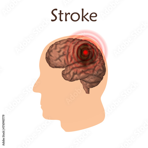 Stoke poster, banner. Vector medical illustration. White background, pink silhouette of man head, anatomy image of damaged human brain.
