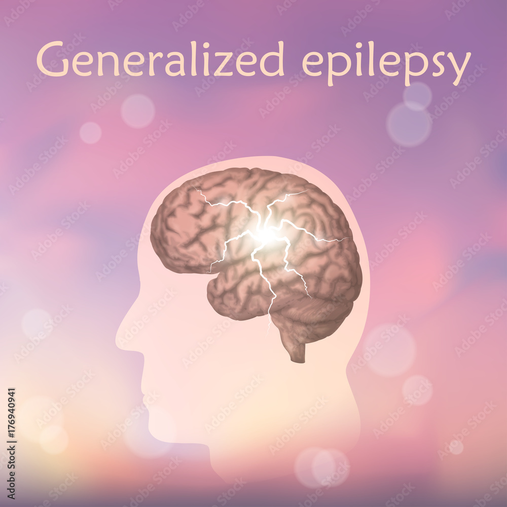Generalized epilepsy. Vector medical illustration. Blurred pink background, silhouette of man, anatomy image of brain, electrical discharge. Generalized epilepsy. Vector medical illustration. Blurred pink background, silhouette of man, anatomy image of brain, electrical discharge.