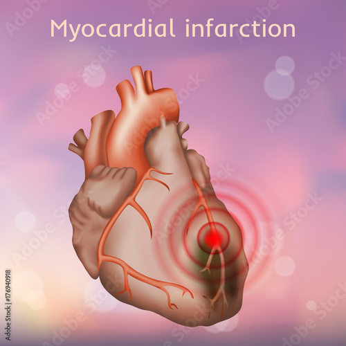 Myocardial infarction. Heart attack, pain. Damaged heart muscle. Anatomy illustration. Red image, blurred pink background.