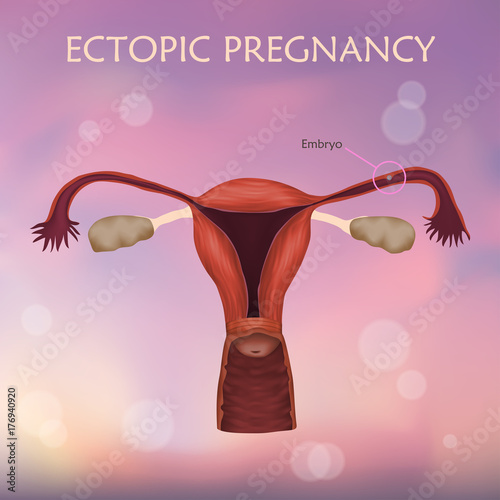 Ectopic pregnancy. The fertilized egg, uterus, womb. Anatomy illustration. Blurred pink background.