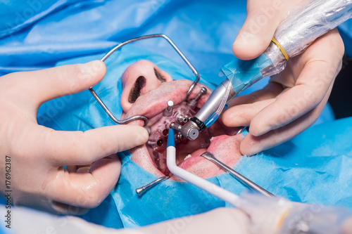 Close up of digital guided surgery on patient. A new technology in dentistry.