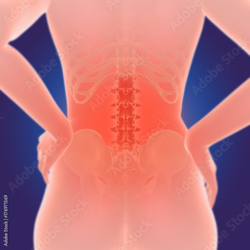 Wirbelsäule - Ischias - chronische Rückenschmerzen photo