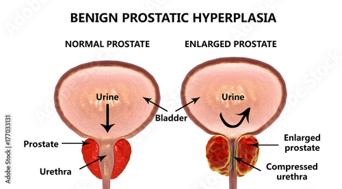Benign prostatic hyperplasia, 3D illustration showing normal and enlarged prostate gland