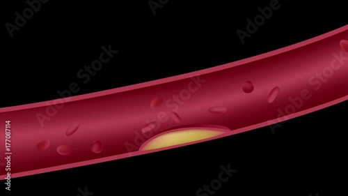 Atherosclerosis animation - Cholesterol plaque forming in artery, ruptures,  blood clot blocking an  artery. 