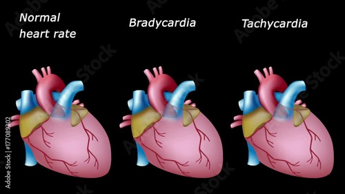 Sinus bradycardia and tachycardia: normal and pathological heart rates, loopable animation.  photo