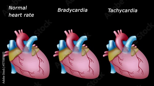Sinus bradycardia and tachycardia: normal and pathological heart rates, loopable animation. 