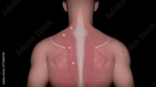 Trigger points and referred pain, animation