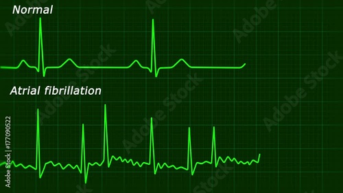 Atrial fibrillation ECG loop animation