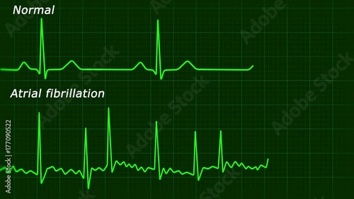 Atrial fibrillation ECG loop animation photo