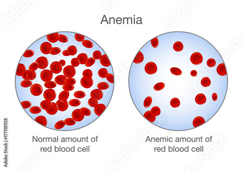 The difference of Anemia amount of red blood cell and normal. Illustration about medical. photo