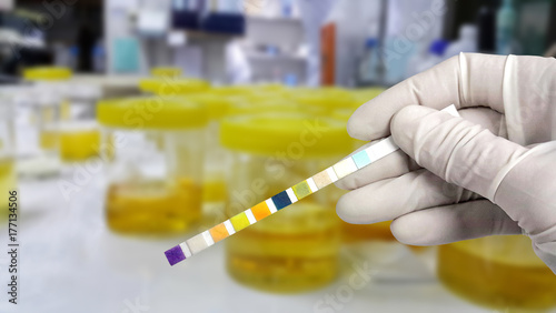 Foto Hand in white glove holding urine strip positive leukocyte esterase for diagnosis urinary tract infection with blur background