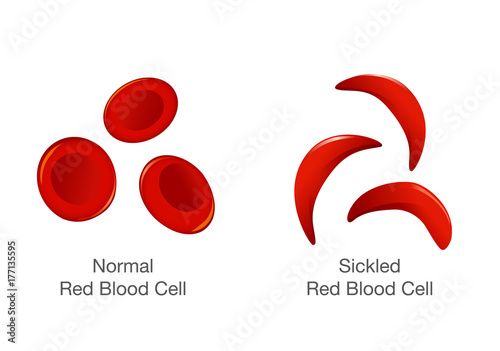 The difference of Normal red blood cell and sickle cell. Illustration about medical.