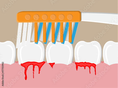 Periodontal disease, bleeding gums