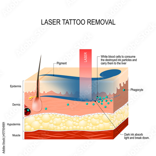 Laser tattoo removal