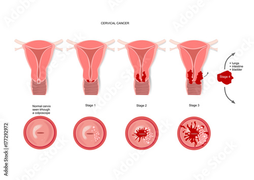 Cervical cancer and its various stages photo
