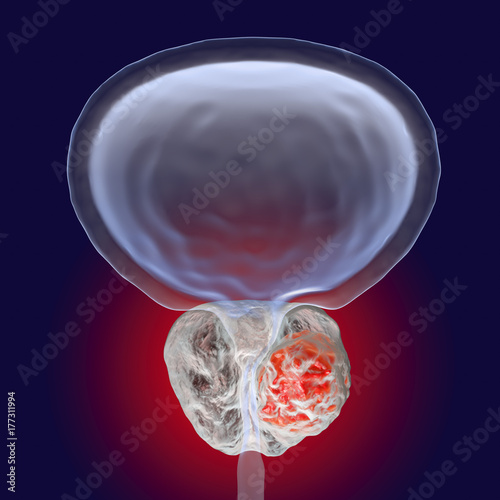 Prostate cancer, 3D illustration showing presence of tumor inside prostate gland which compresses urethra photo