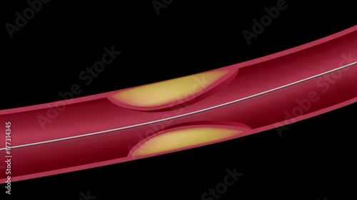 Balloon angioplasty procedure, animation