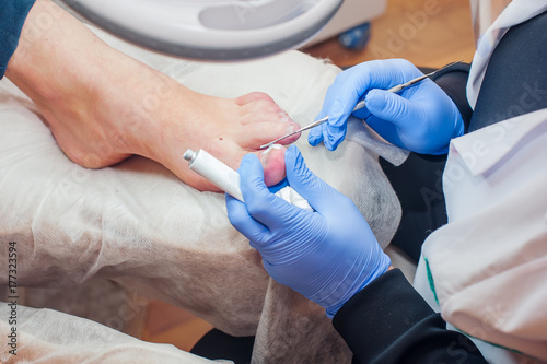 Podology treatment. Podiatrist treating toenail fungus. Doctor removes calluses, corns and treats ingrown nail. Hardware manicure. Health, body care concept. Selective focus photo
