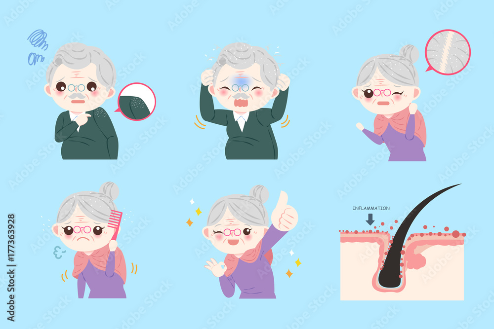 old people with dandruff problem old people with dandruff problem