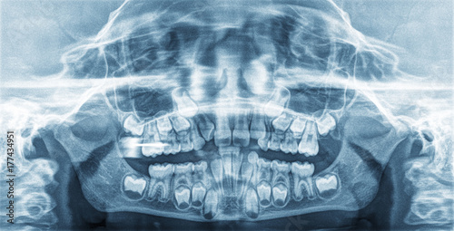 Panoramic X-Ray teeth of a child photo