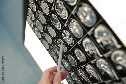 Doctor shows with pen on the brain lesion photo