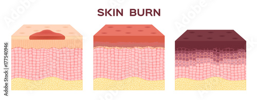 step of burn . Normal to serious burn skin . vector and icon