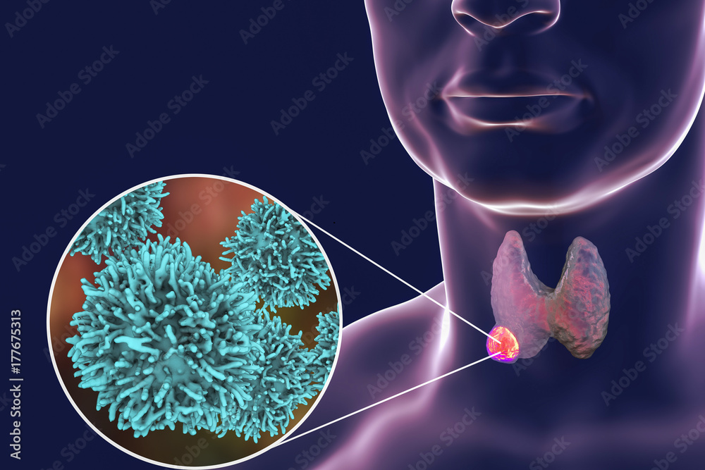 Thyroid cancer. 3D illustration showing thyroid gland with tumor inside ...