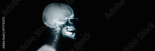 Radiographie du crâne avec lunettes